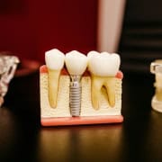diş implantı bakımı