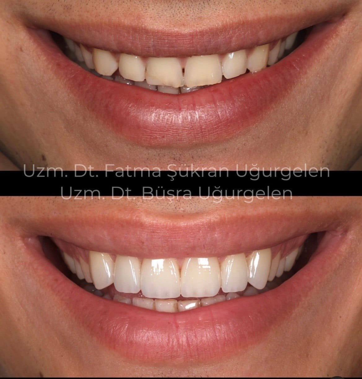 lamine veneer gülüş tasarımı öncesi sonrası