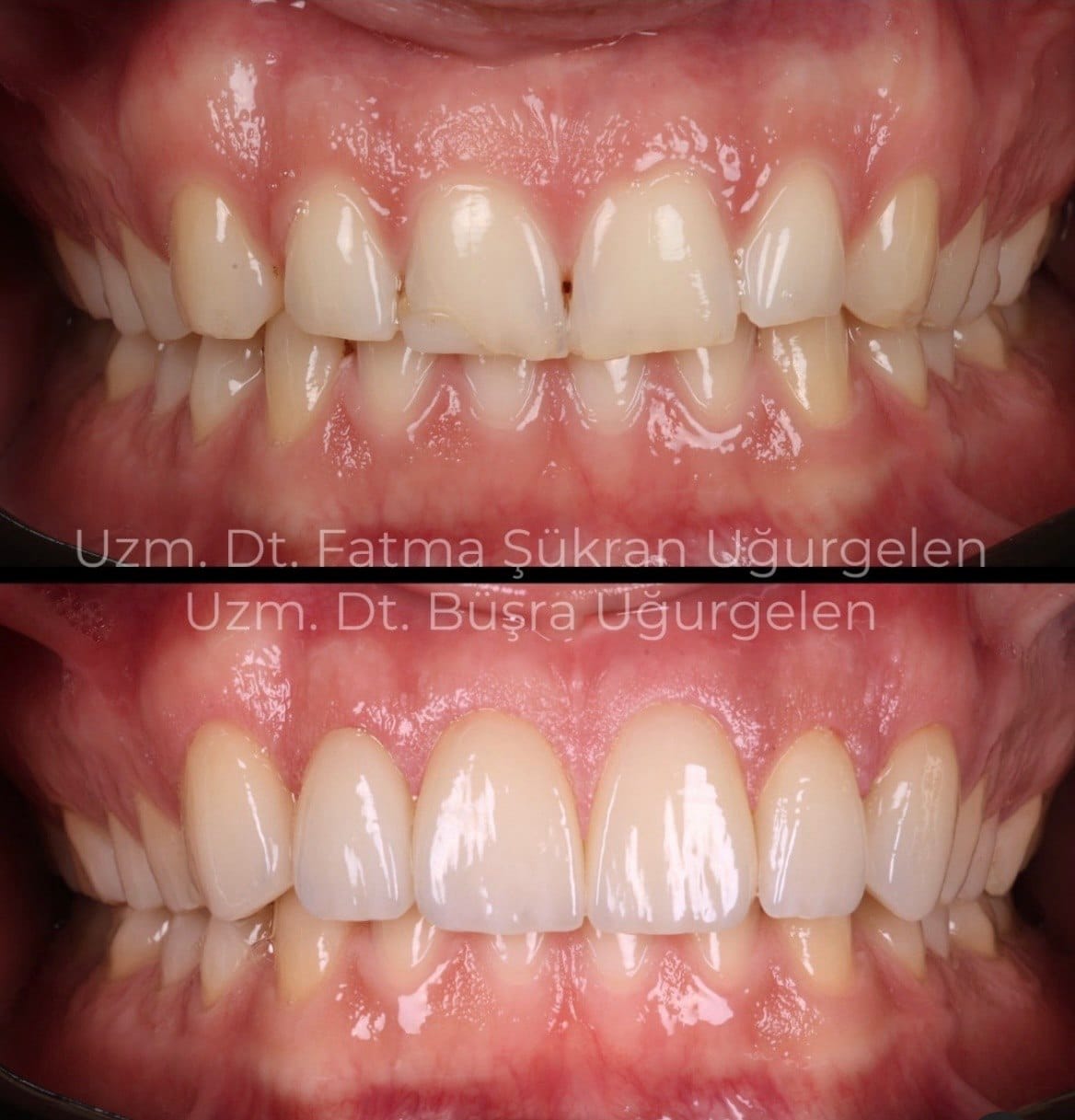 lamine veneer öncesi sonrası diastema kapatma