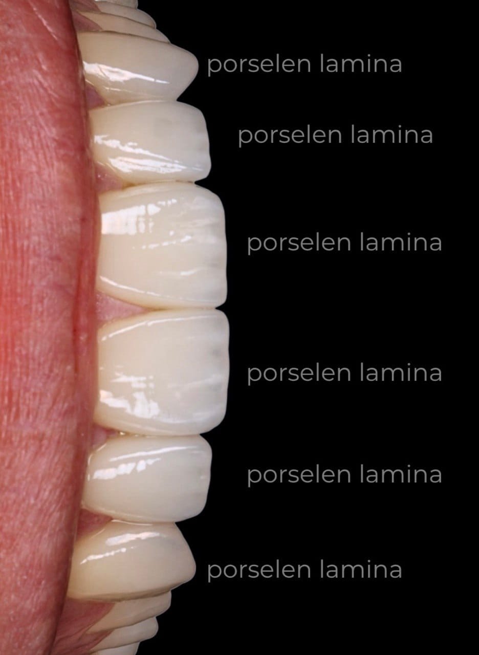 porselen lamina ince yapısı yakın çekim